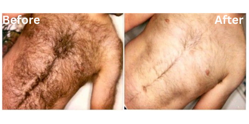 Results Permanent Choice Permanent Choice Laser Hair Removal